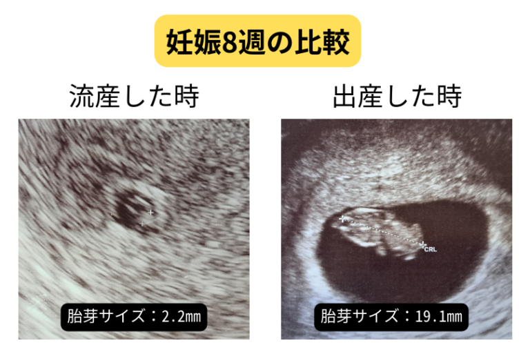 【エコー比較】流産した時 出産した時の違いは？妊娠初期のエコーと症状を週別で比較 心配性olのマタニティブログ～妊娠・流産・子育ての記録～